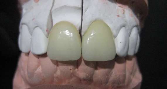 Importancia de las prótesis dentales en la salud bucodental