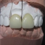 Importancia de las prótesis dentales en la salud bucodental